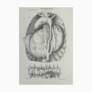 Ottavio Muzzi, Artery Disease, Lithograph, 1843-ZCI-2029979