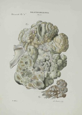 Ottavio Muzzi, Bone Disease, Lithograph, 1843-ZCI-2029955