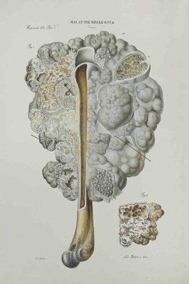 Ottavio Muzzi, Bone Disease, Lithograph, 1843-ZCI-2029994