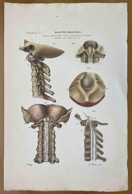 Ottavio Muzzi, Bone Diseases, Lithograph, 1843-ZCI-2030158