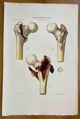 Ottavio Muzzi, Bone Diseases, Lithograph, 1843-ZCI-2030148