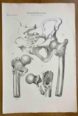 Ottavio Muzzi, Bone Diseases, Lithograph, 1843-ZCI-2030149