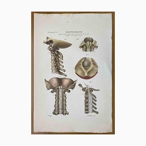 Ottavio Muzzi, Bone Diseases, Lithograph, 1843-ZCI-2030158