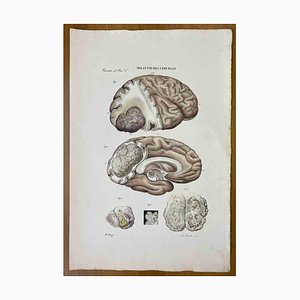 Ottavio Muzzi, Brain Disease, Lithograph, 1843-ZCI-2030156