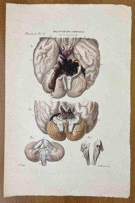 Ottavio Muzzi, Brain Diseases, Lithograph, 1843-ZCI-2030151