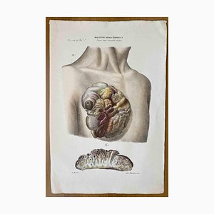 Ottavio Muzzi, Breast Diseases, Lithograph, 1843-ZCI-2030129