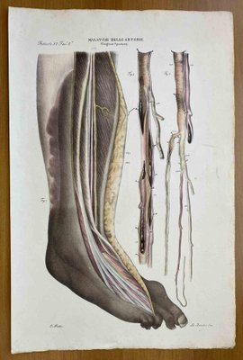 Ottavio Muzzi, Diseases of the Arteries, Lithograph, 1843-ZCI-2030169