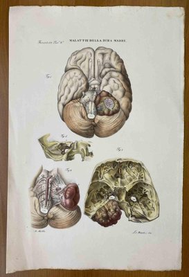 Ottavio Muzzi, Diseases of the Dura Mater, Lithograph, 1843-ZCI-2030162