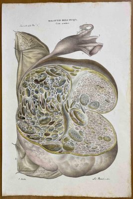 Ottavio Muzzi, Diseases of the Ovary, Lithograph, 1843-ZCI-2030177