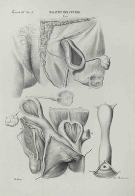 Ottavio Muzzi, Diseases of the Uterus, Lithograph, 1843-ZCI-2029980