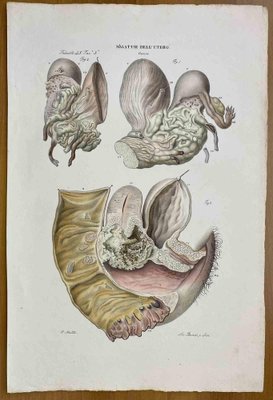 Ottavio Muzzi, Diseases of Uterus, Lithograph, 1843-ZCI-2030139