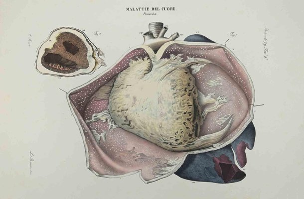 Ottavio Muzzi, Heart Disease, Lithograph, 1843-ZCI-2029966