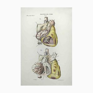 Ottavio Muzzi, Heart Disease, Lithograph, 1843-ZCI-2029977