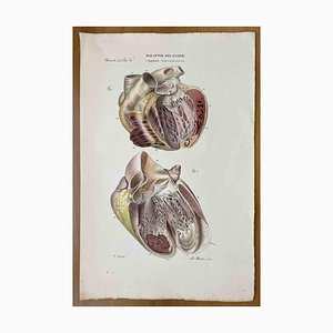 Ottavio Muzzi, Heart Diseases, Lithograph, 1843-ZCI-2030147