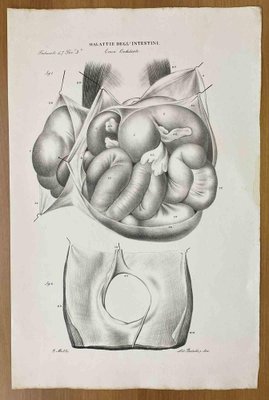 Ottavio Muzzi, Intestinal Diseases, Lithograph, 1843-ZCI-2030175