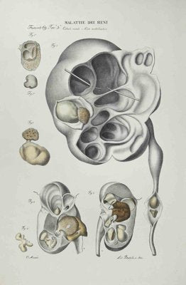 Ottavio Muzzi, Kidney Disease, Lithograph, 1843-ZCI-2029999