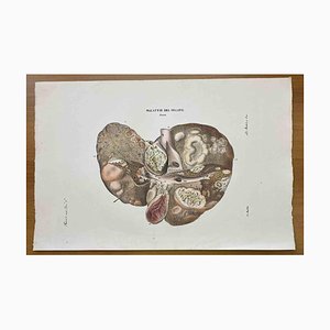 Ottavio Muzzi, Liver Disease, Lithograph, 1843-ZCI-2030150